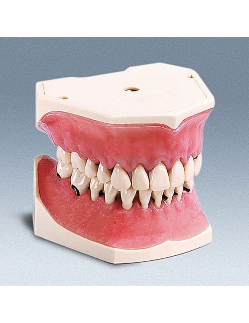 MODELE MAXILLAIRE ET MANDIBULE DENTURE PARODONTALE  27 DENTS